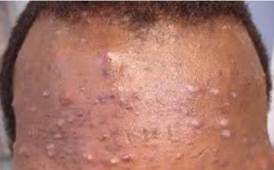 Inflammation Is the Root of Hyperpigmentation—Here’s What to Do