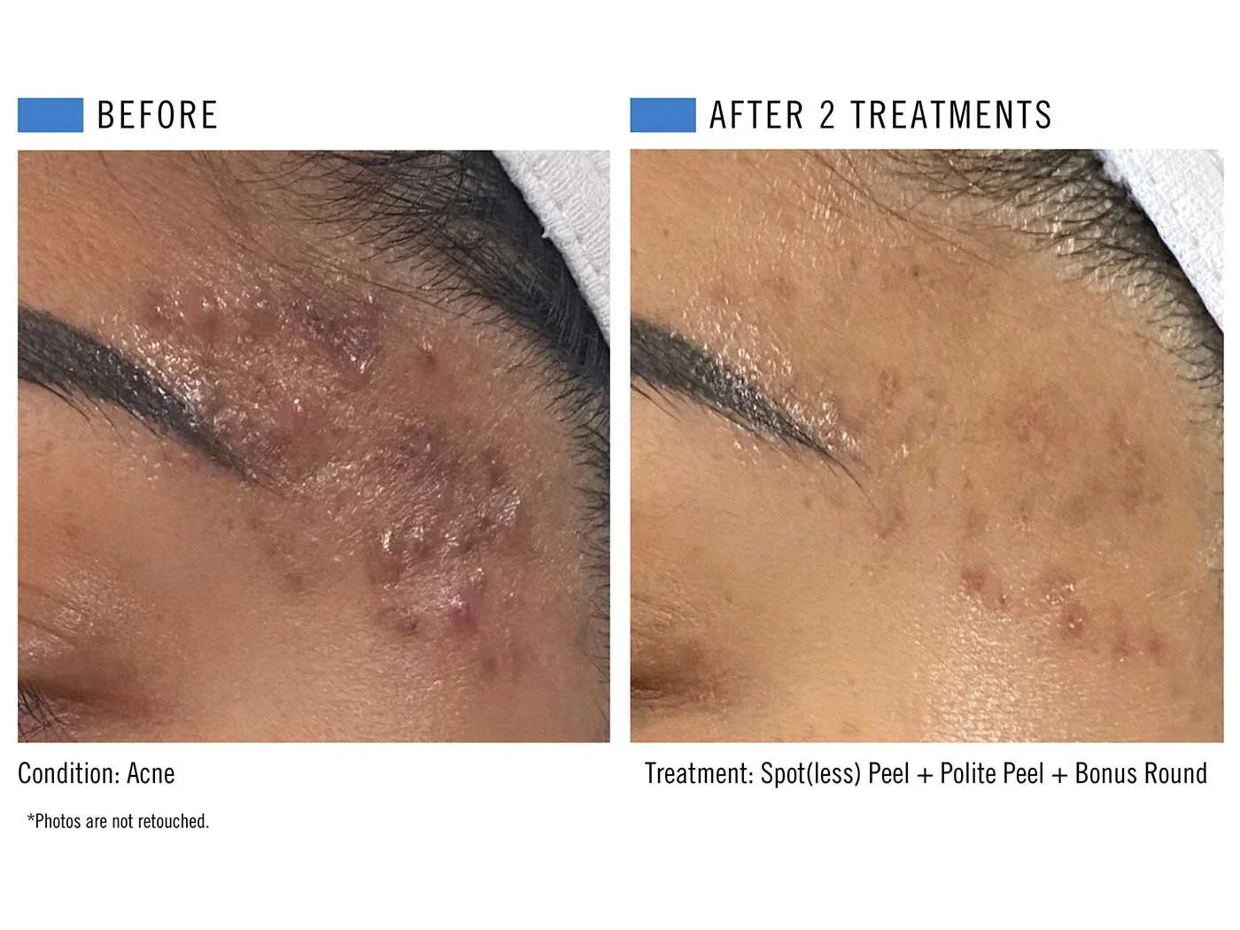 Yes, You Can Get a Chemical Peel in the Summer—Here’s How