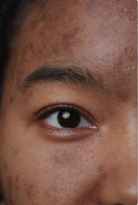 Why Hyperpigmentation Lingers Longer on Deeper Skin Tones