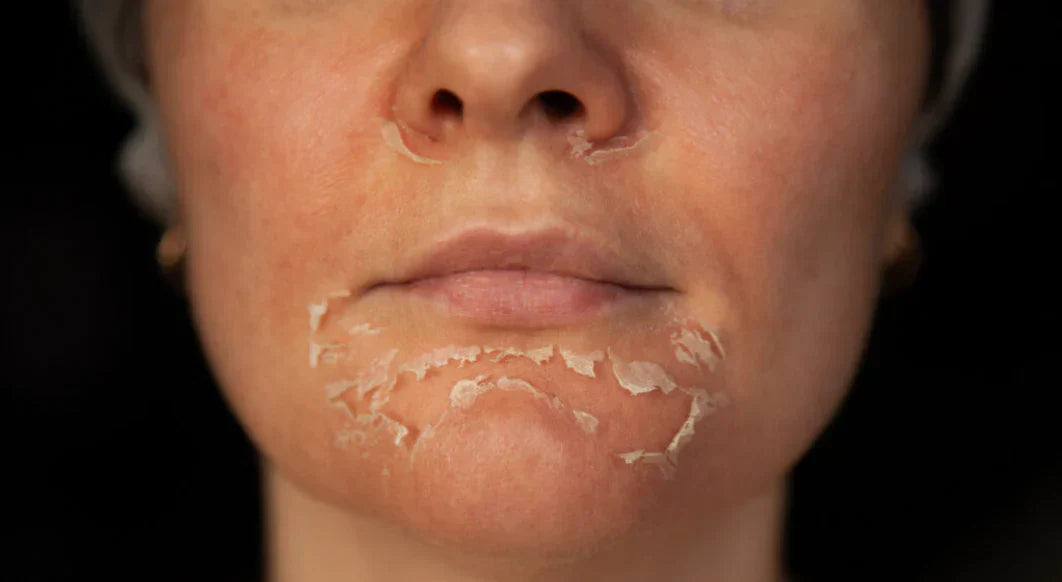 The Best Chemical Peels for Melanin-Rich Skin in Hot Weather